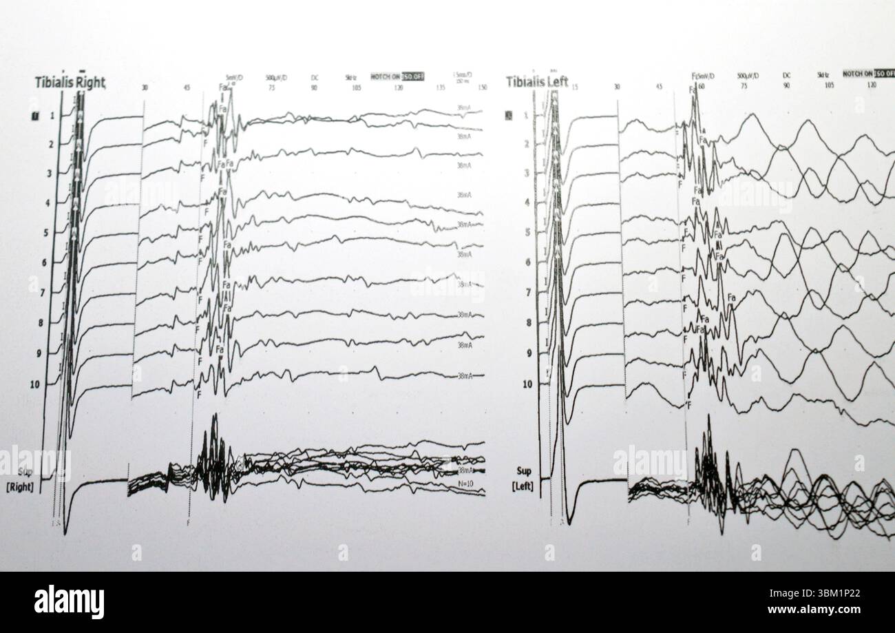 Electromyography emg hi-res stock photography and images - Alamy