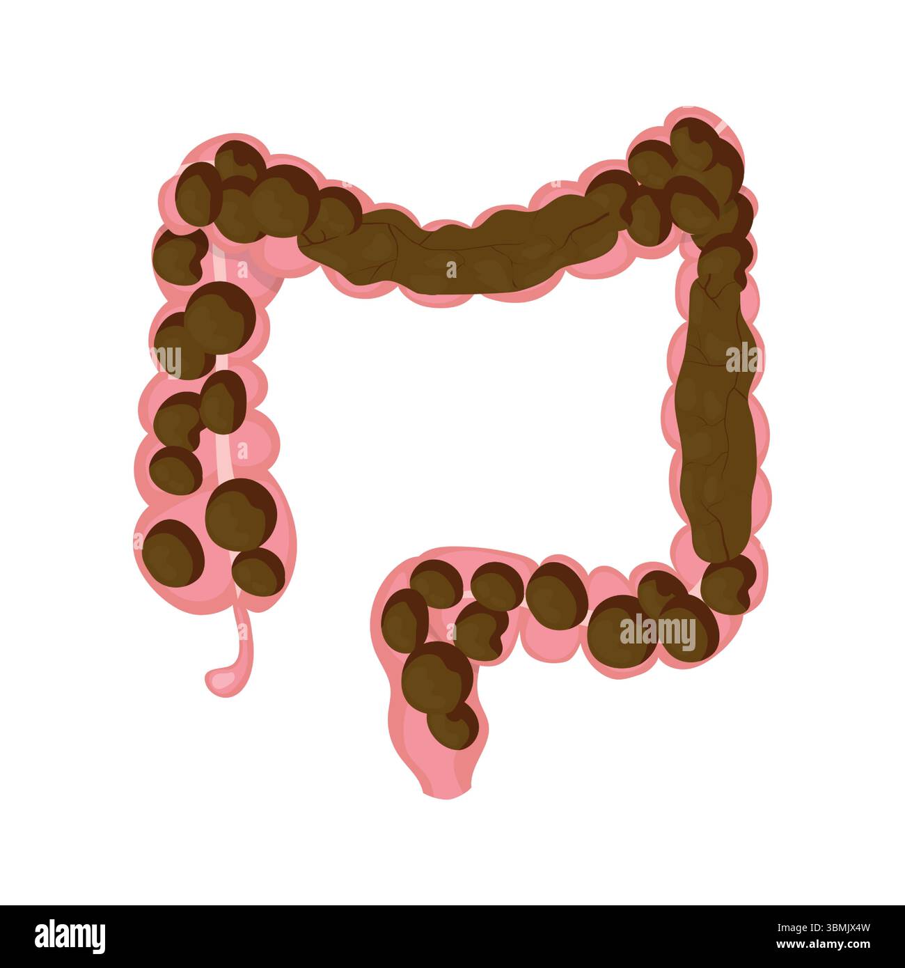 Intestines showing constipation with dry and hard stool, medical ...