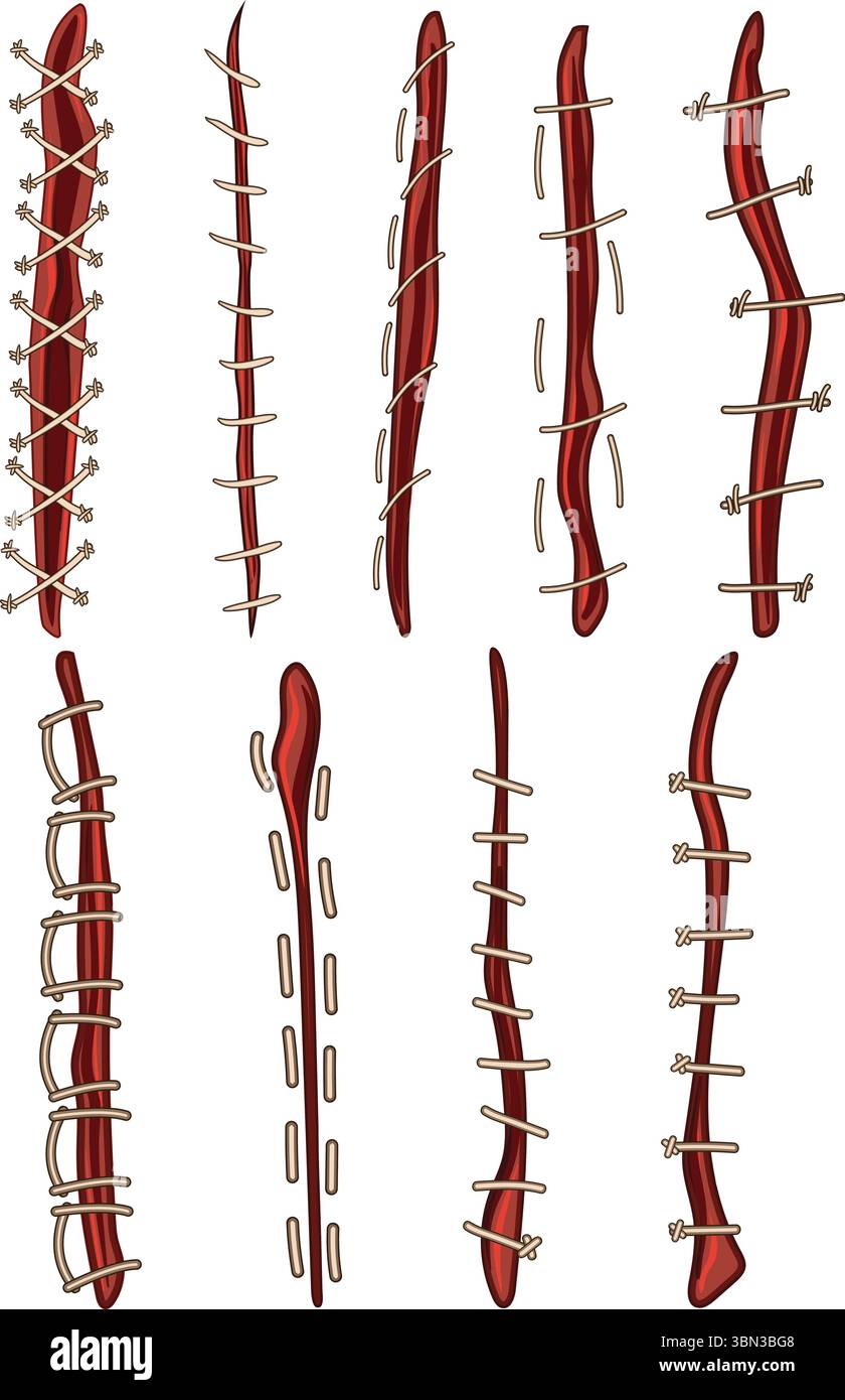 Suture Pattern Cartoon suture set cartoon vector illustration Stock Vector Image & Art - Alamy