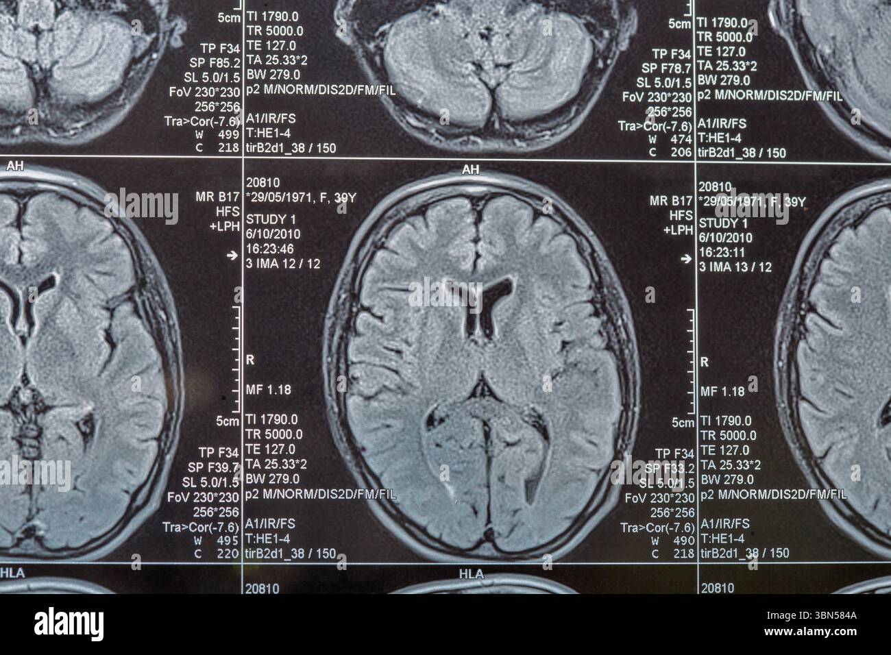 Magnetic resonance imaging or MRI image of the brain closeup Stock ...