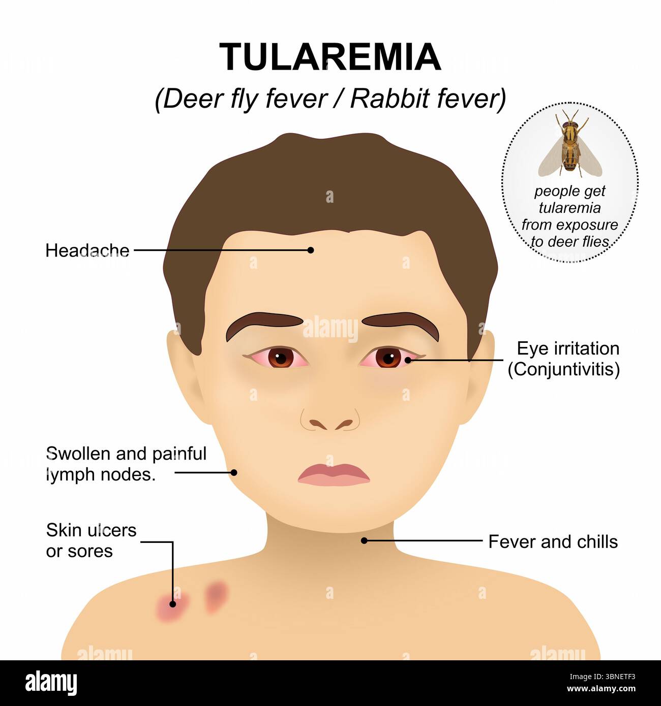 Rabbit Rash Tularemia - Deer fly fever / Rabbit fever sign and symptoms Stock Photo ...