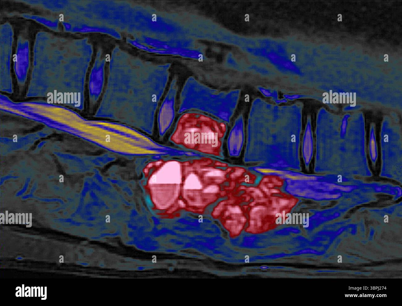 Coloured agnetic resonance image (MRI) scan of the spine of a 15 year ...