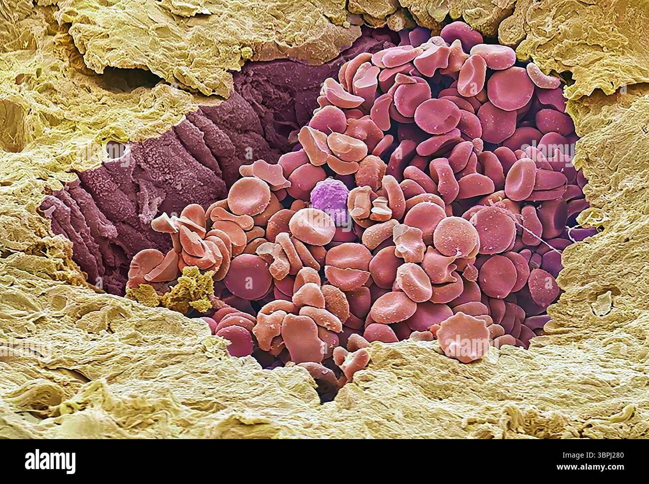 Coronary blood vessel. Coloured scanning electron micrograph (SEM) of a ...