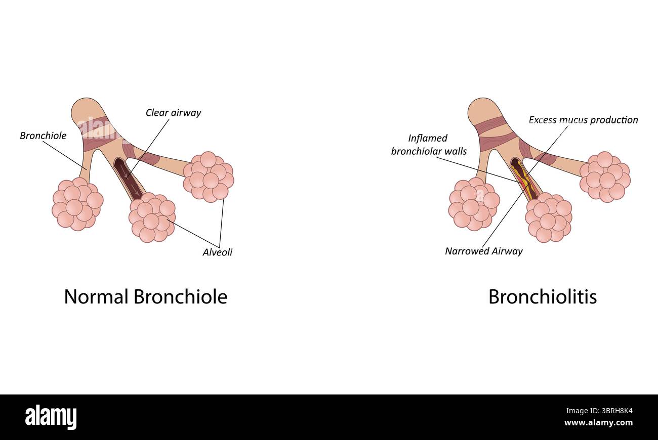 Bronchiolitis vector illustration Stock Vector