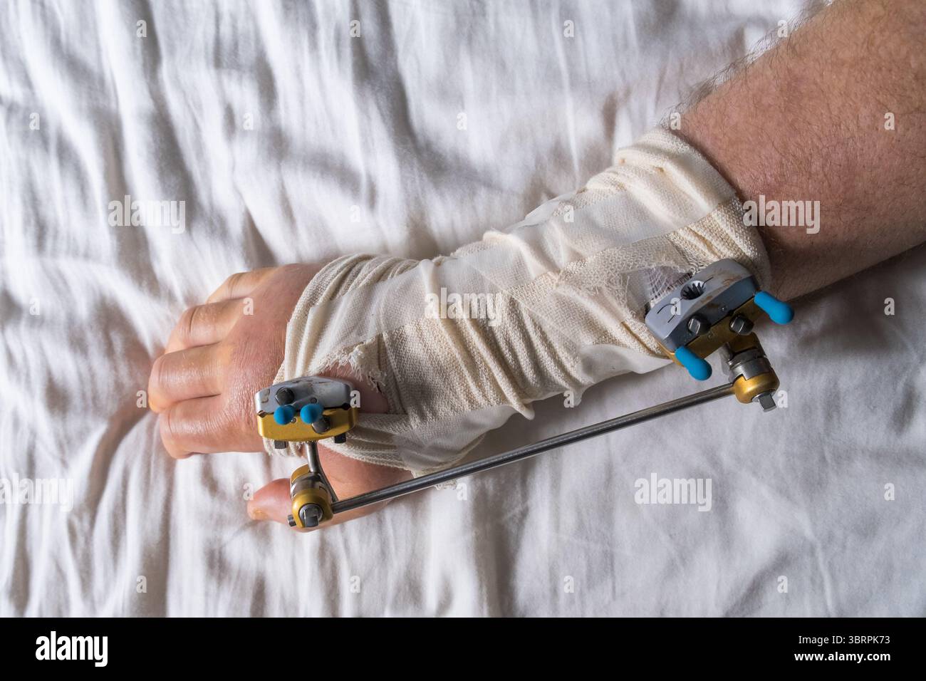 External fixator for a wrist fracture Stock Photo - Alamy