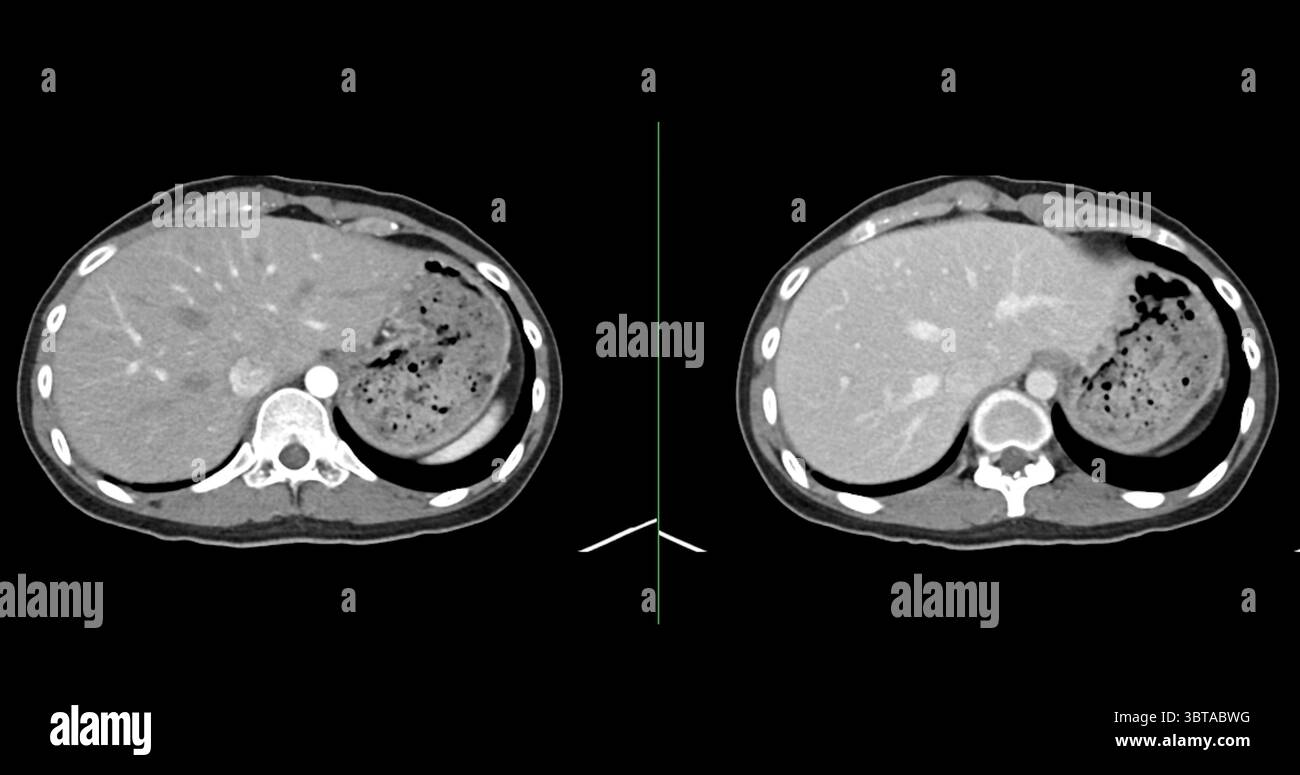 Contrast-enhanced CT whole abdomen study revealing normal anatomical ...