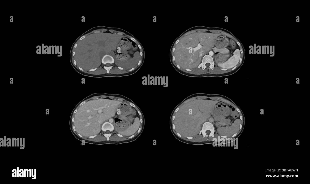 Contrast-enhanced CT whole abdomen study revealing normal anatomical ...