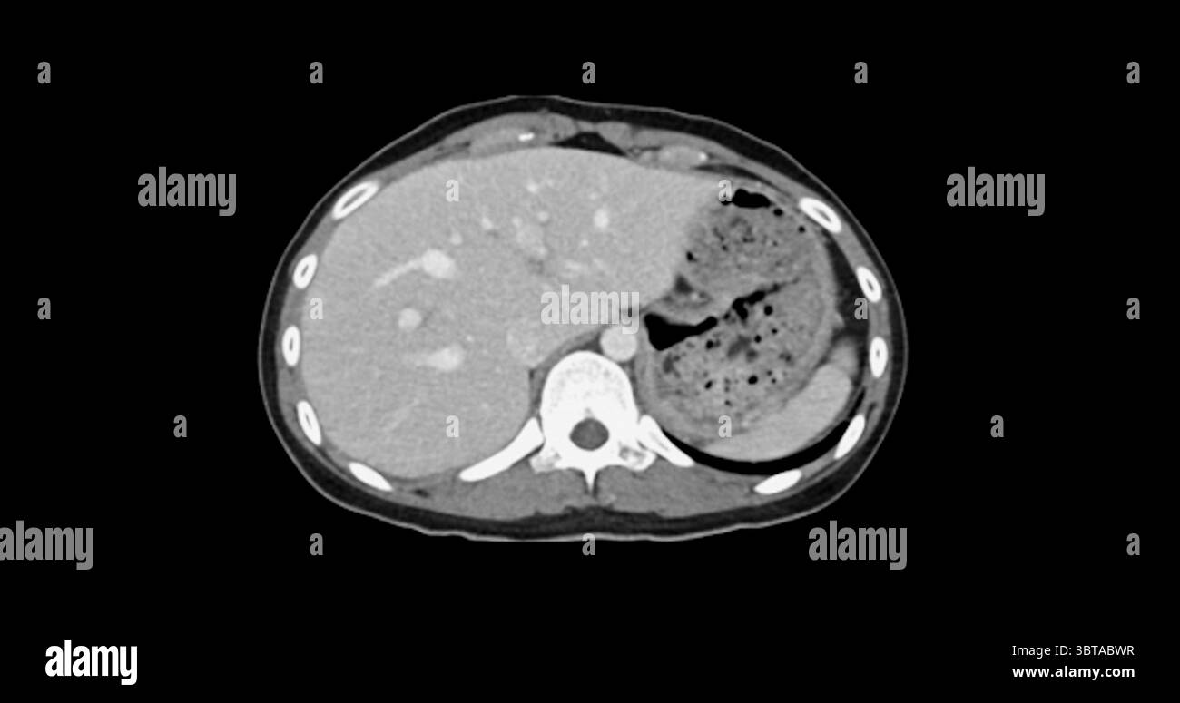 Contrast-enhanced CT whole abdomen study revealing normal anatomical ...
