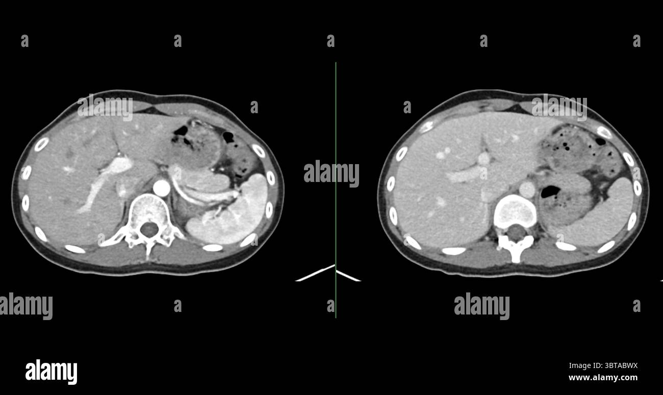Contrast-enhanced CT whole abdomen study revealing normal anatomical ...