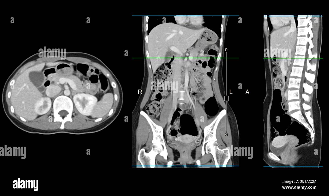 Contrast-enhanced CT whole abdomen study revealing normal anatomical ...