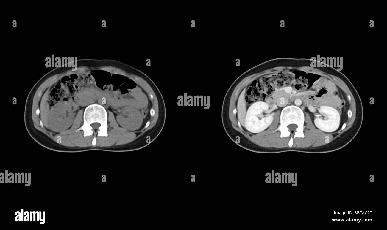 Contrast-enhanced CT whole abdomen study revealing normal anatomical ...
