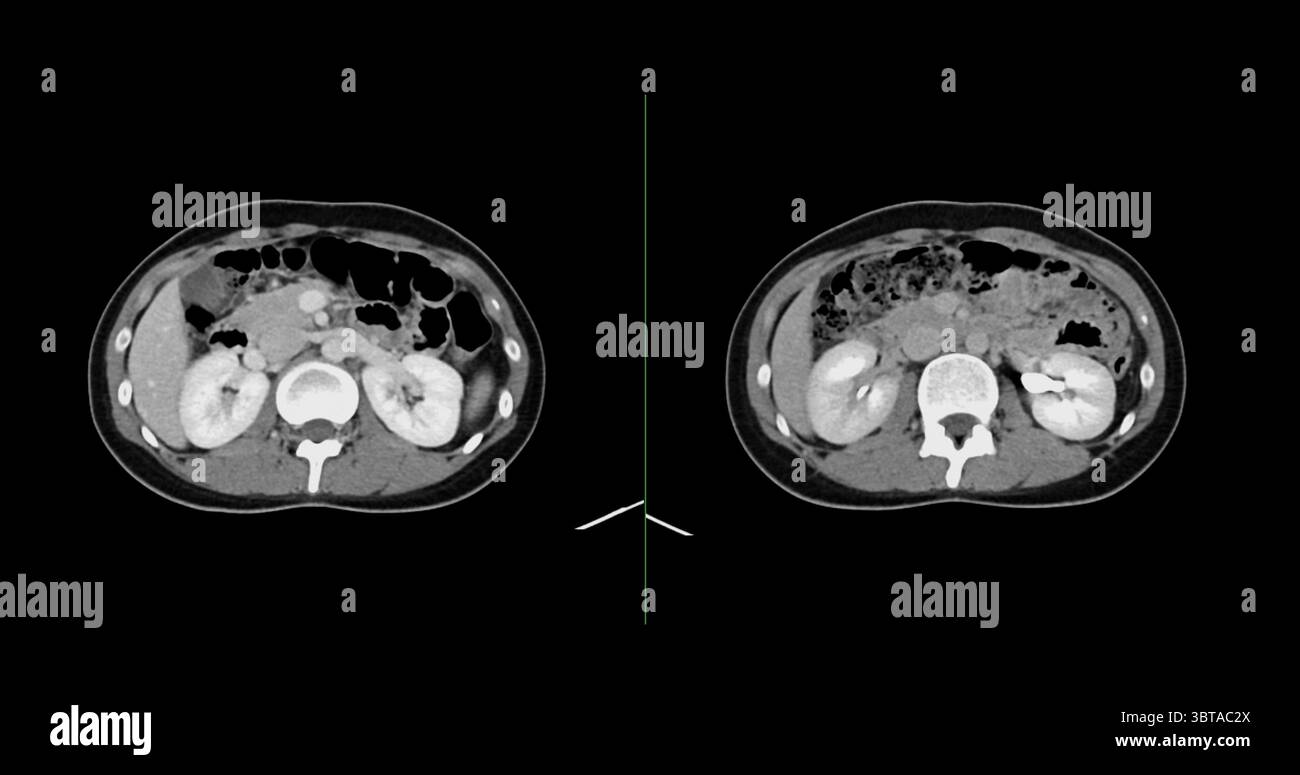 Contrast-enhanced CT whole abdomen study revealing normal anatomical ...
