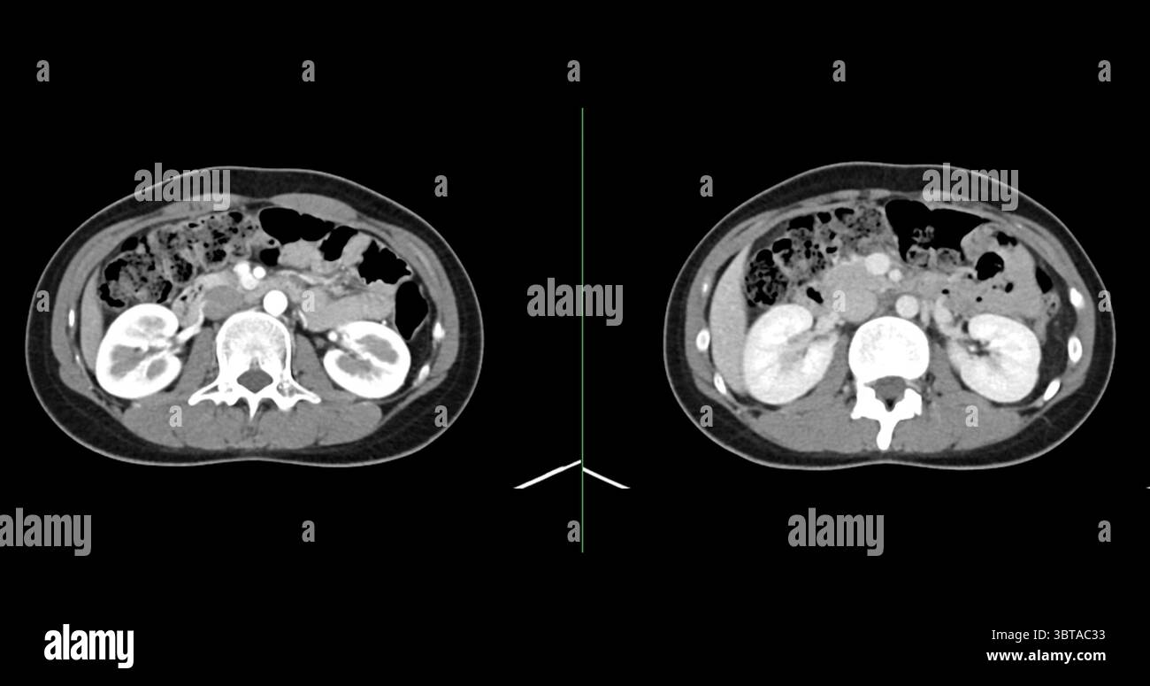 Contrast-enhanced CT whole abdomen study revealing normal anatomical ...