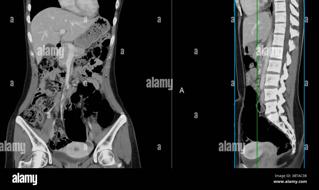 Contrast-enhanced CT whole abdomen study revealing normal anatomical ...