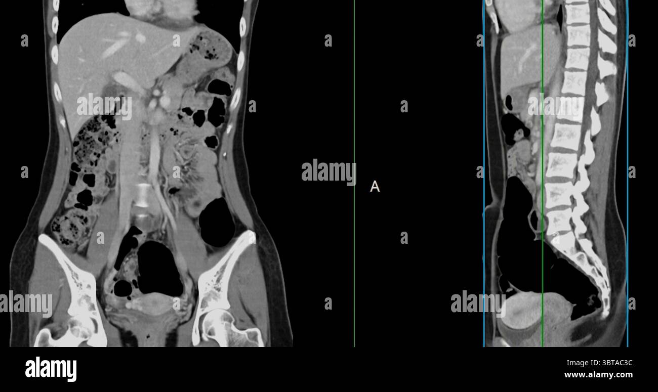 Contrast-enhanced CT whole abdomen study revealing normal anatomical ...