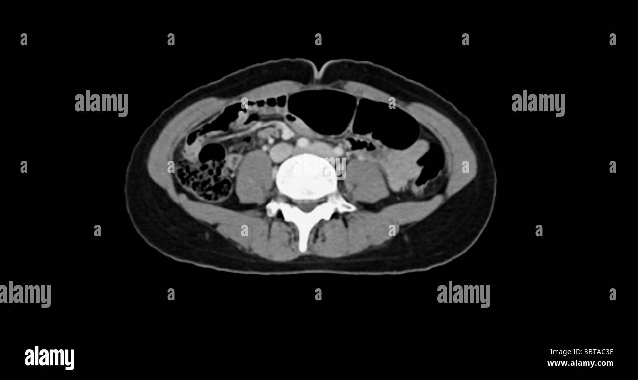 Contrast-enhanced CT whole abdomen study revealing normal anatomical ...