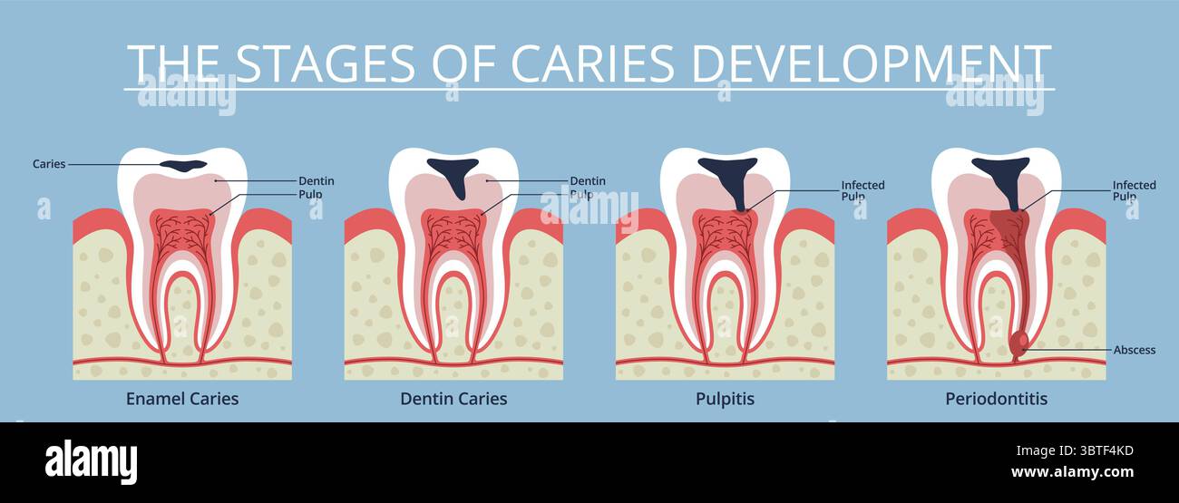 Caries stages. Gradual tooth decay process, enamel integrity violation ...