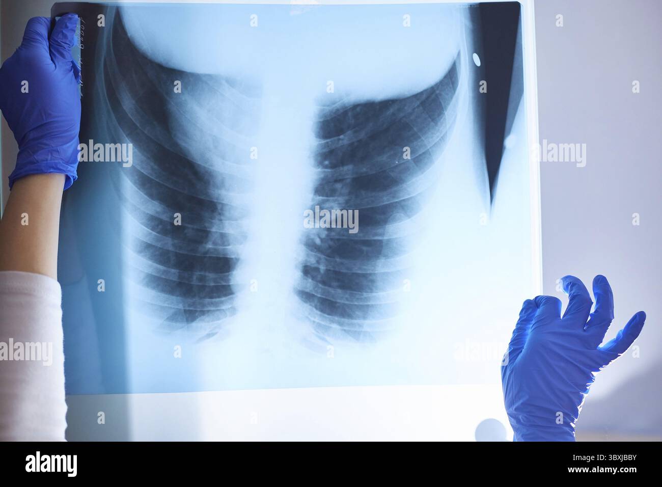 X-ray of the lungs in the hands of a medical professional Stock Photo ...