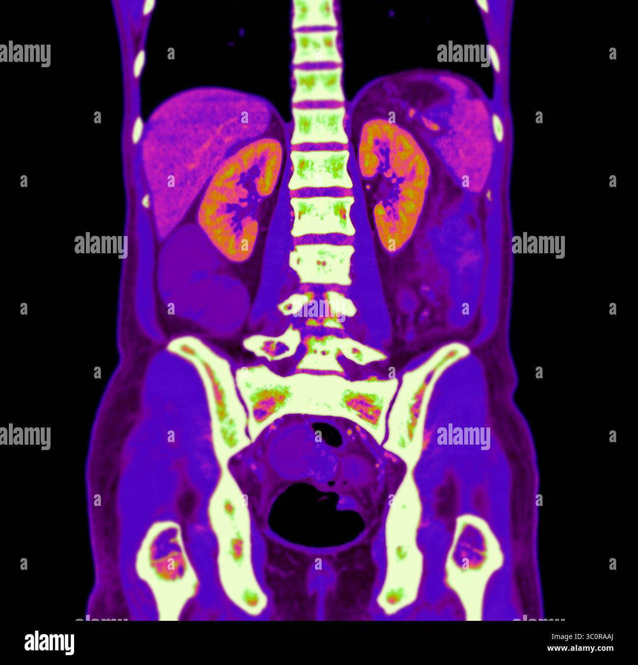 Color Ct Image High-resolution abdominal CT image highlighting vascular and organ ...
