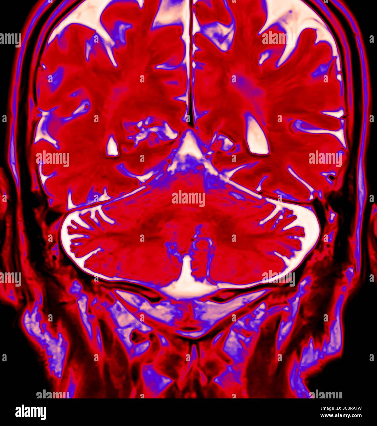 The color-enhanced MRI reveals the brain’s anatomy in striking hues. It ...