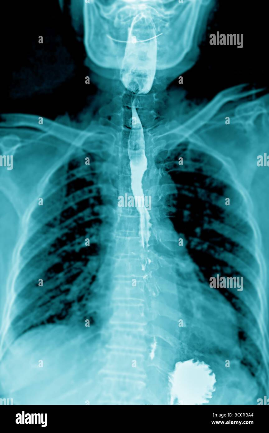 Fluoroscopic footage of a barium swallow test showing real-time ...