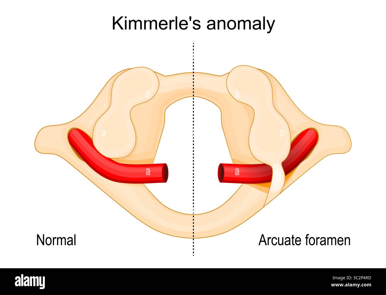 Arcuate foramen. Ponticulus posticus. Little posterior bridge. Kimmerles anomaly. Atlas structure. First cervical vertebra from above. Detailed Vector Stock Vector