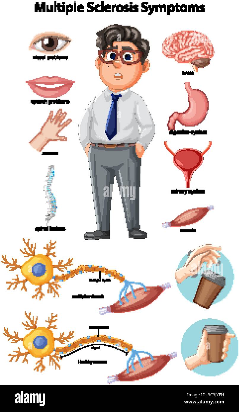 Educational medical vector showing multiple sclerosis symptoms, affected organs, nerve damage, and muscle weakness with labeled diagrams and cartoon c Stock Vector