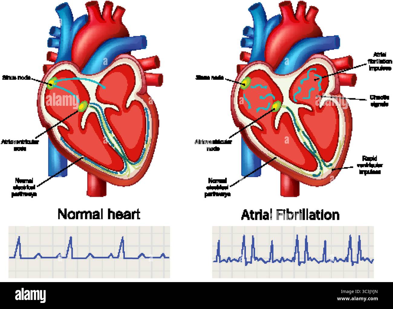 Illustration showing differences between a normal heart and one with atrial fibrillation, highlighting electrical pathways and impulses Stock Vector