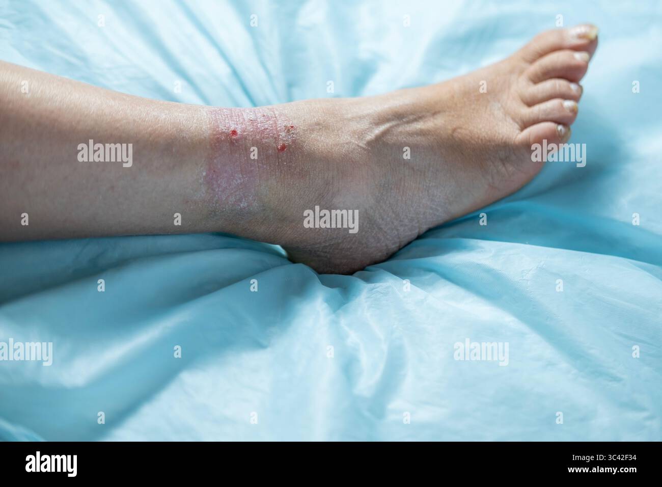 psoriatic rashes on skin with chronic dermatitis, wound on painful ...
