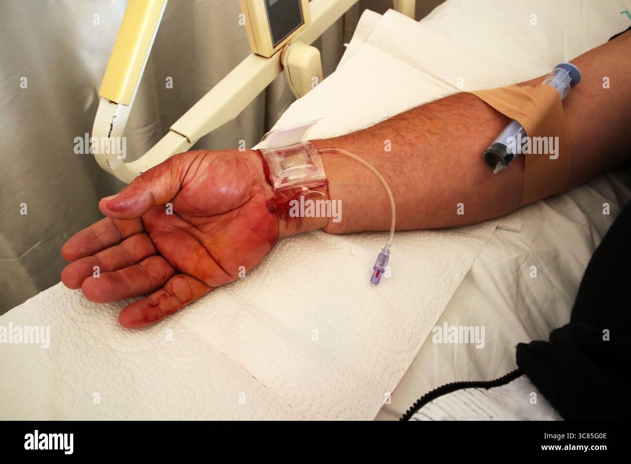 A male patient who had a cardiac angiogram from the arm is waiting for ...