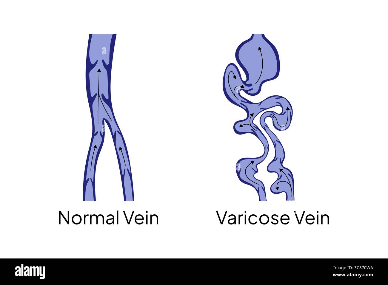 Medical illustration comparing a normal vein with a varicose vein