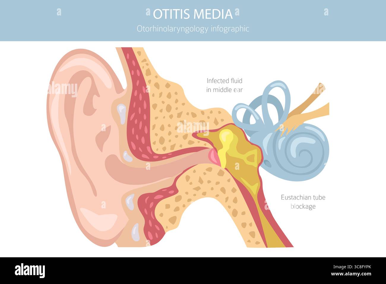 Otitis media. Infection in the middle ear. Otological disorders ...