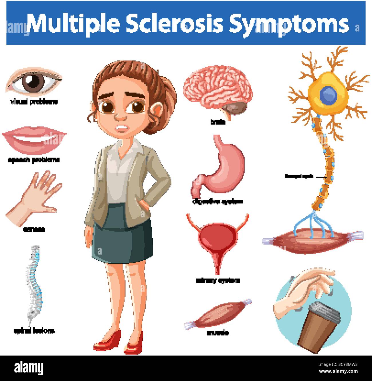 Vector illustration highlights multiple sclerosis symptoms with labeled organs, nervous system elements, and a concerned woman in a clinical, educatio Stock Vector