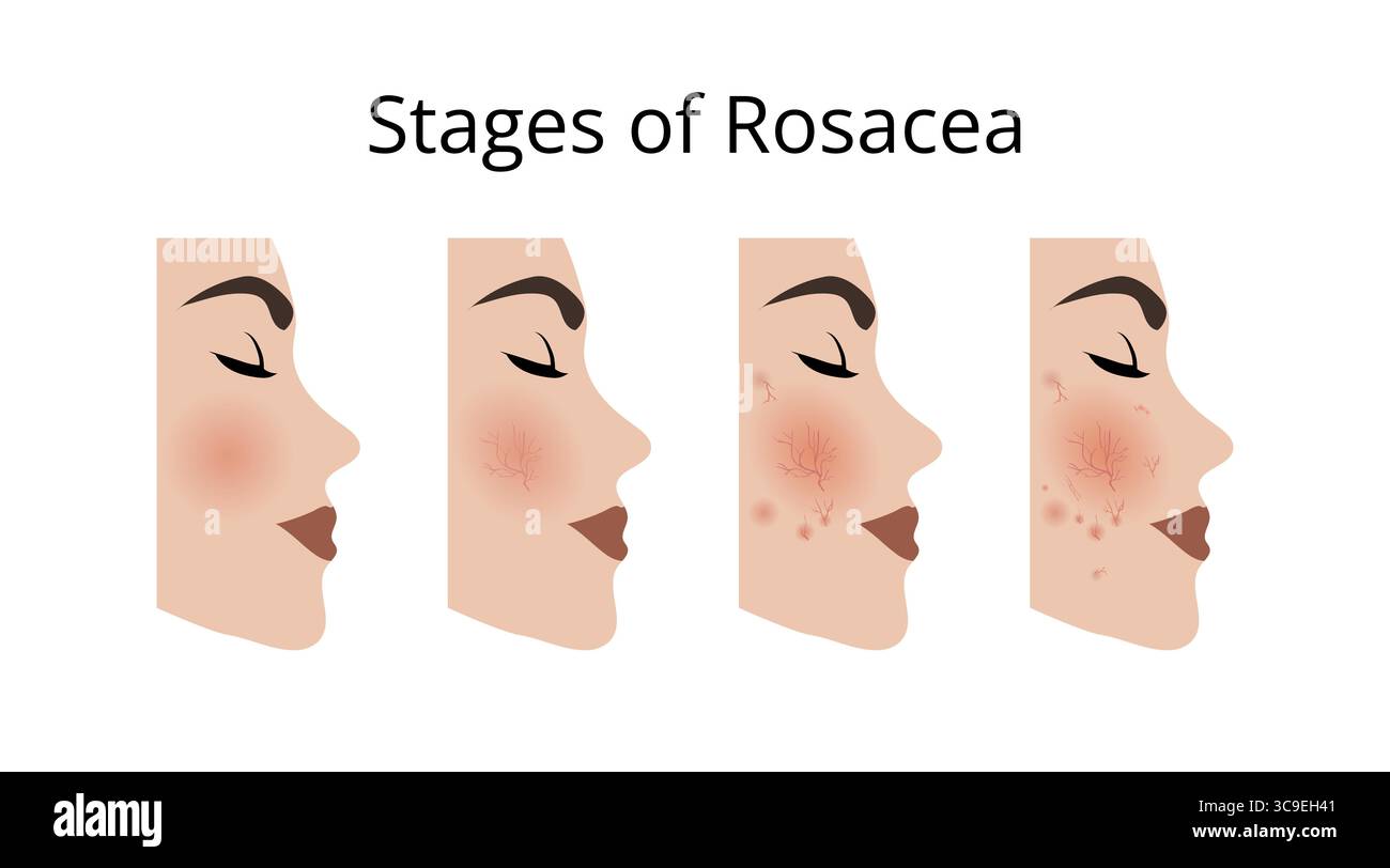 Four faces of a woman showing the different stages of rosacea, a chronic inflammatory skin condition that causes redness, visible blood vessels, and s Stock Vector