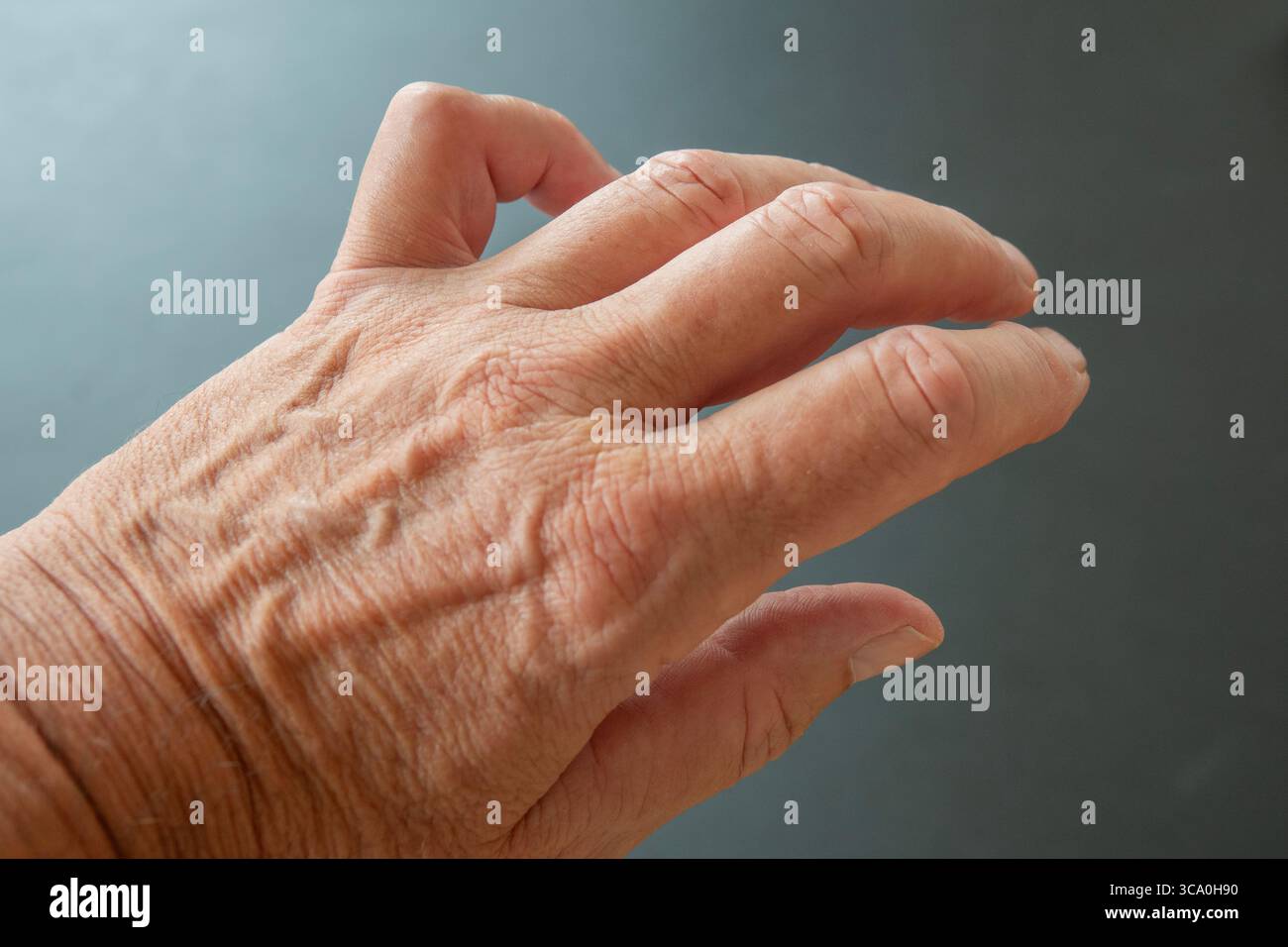 Hand of a person with Dupuytren's contracture - a condition in which one or more fingers become permanently bent in a flexed position. Little finger. Stock Photo