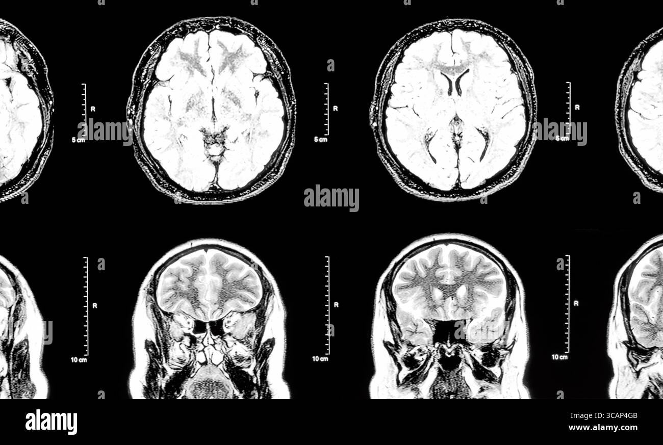 MRI Magnetic resonance image of the human brain and head Stock Photo ...