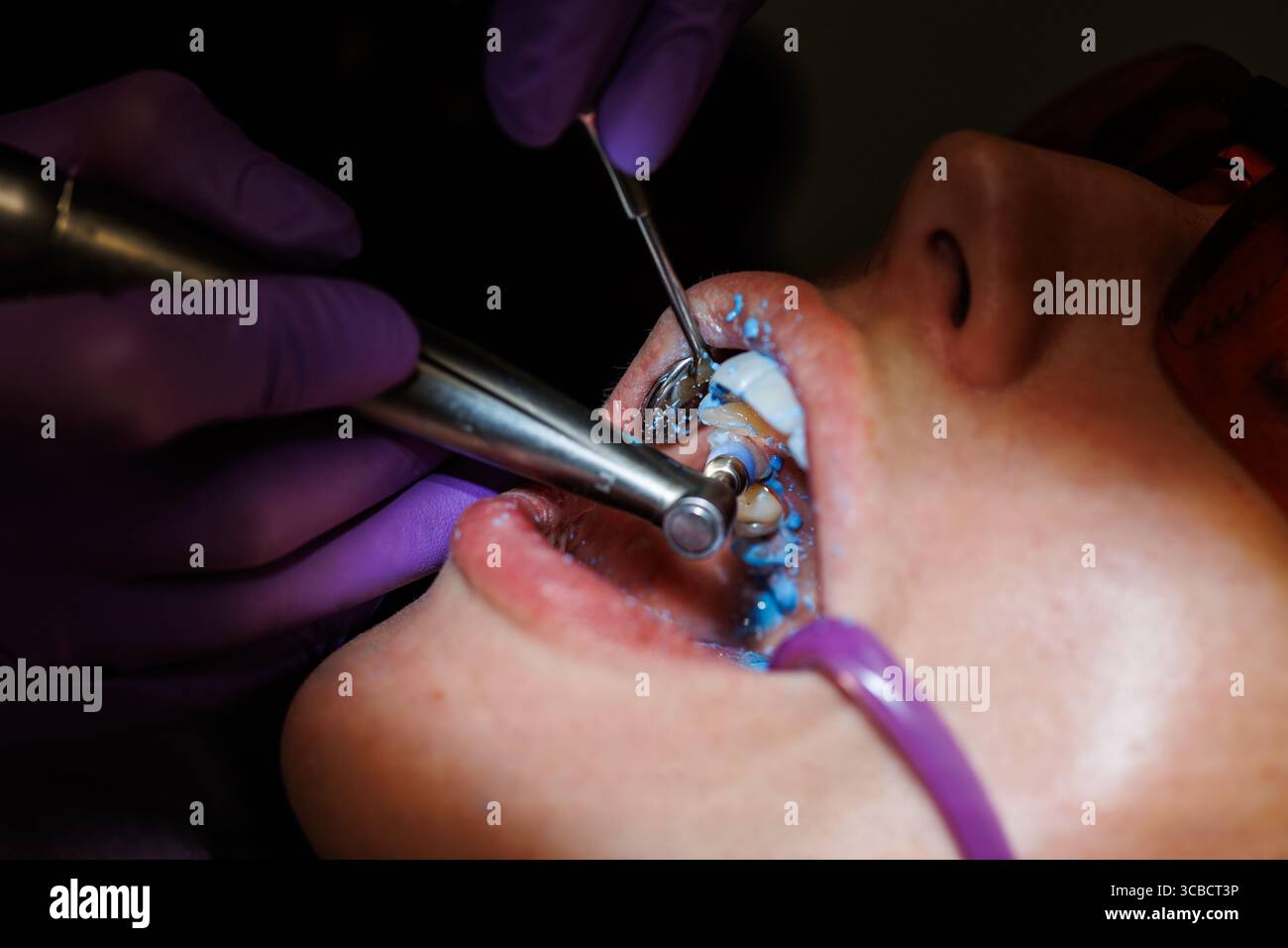 Close-up of dental cavity filling procedure Stock Photo - Alamy