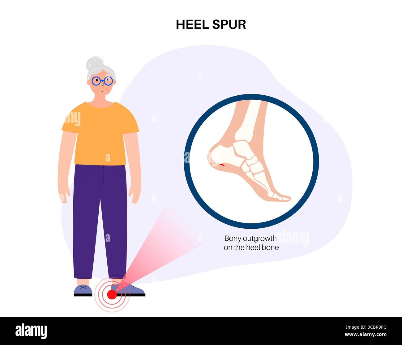 Illustration of a heel spur. This is a bony growth that can develop on ...