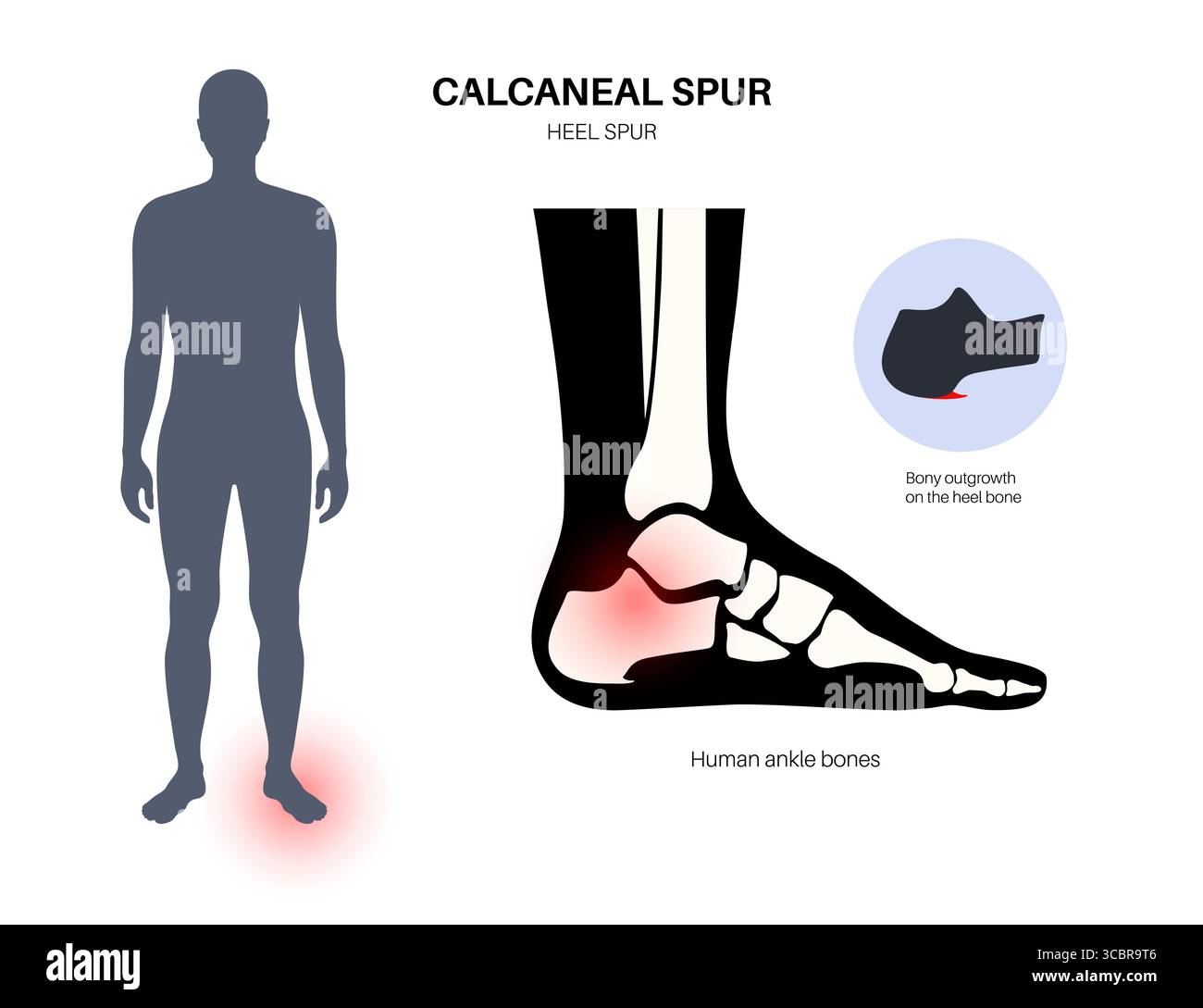 Calcaneal spur anatomy. Foot problem, diagnostic and treatment in ...