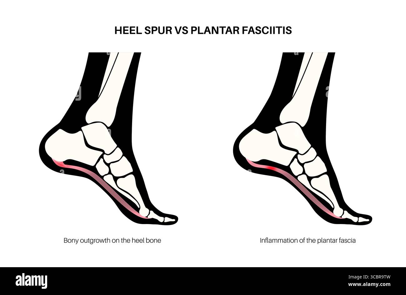 heel bursitis swelling plantar fasciitis comparison image