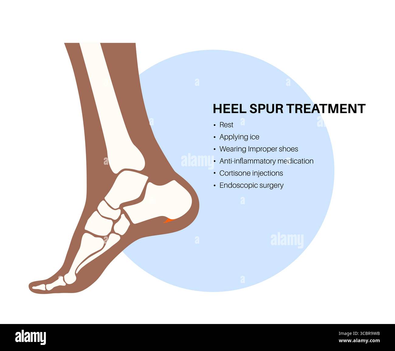Spur Rst Illustration of heel spur treatment such as rest, ice, anti ...