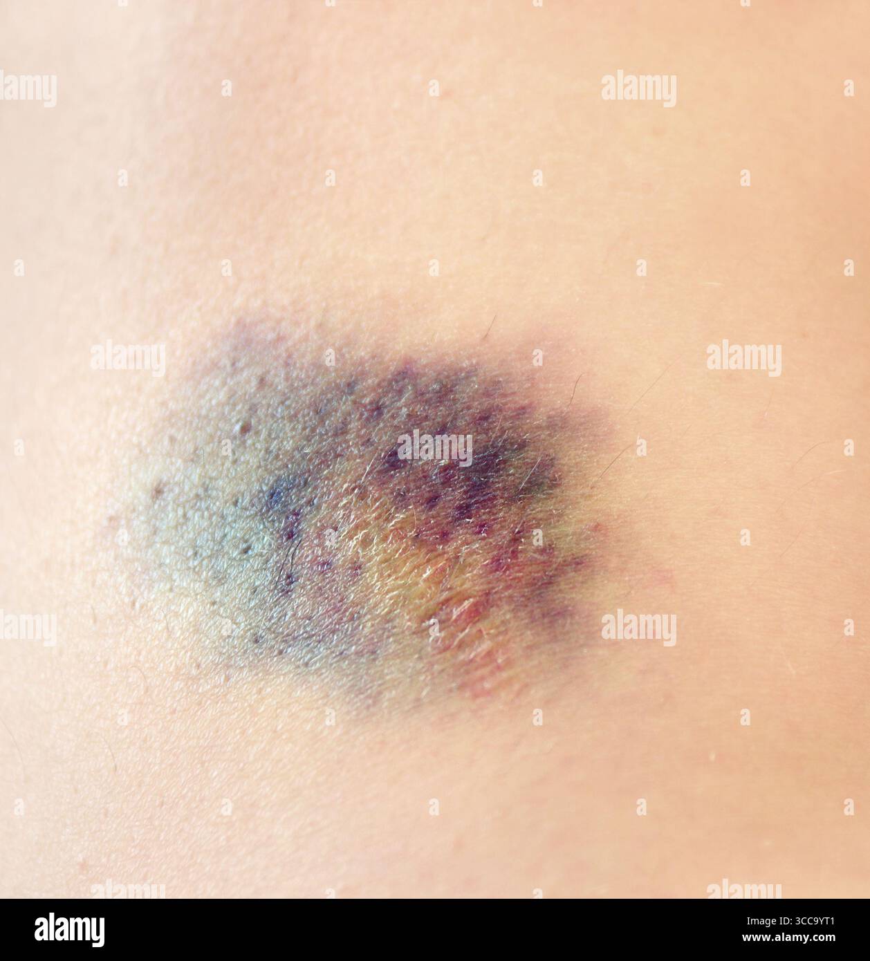 Skin Rippling Close up purple bruise on skin. Bruise from impact. Bruising and ...