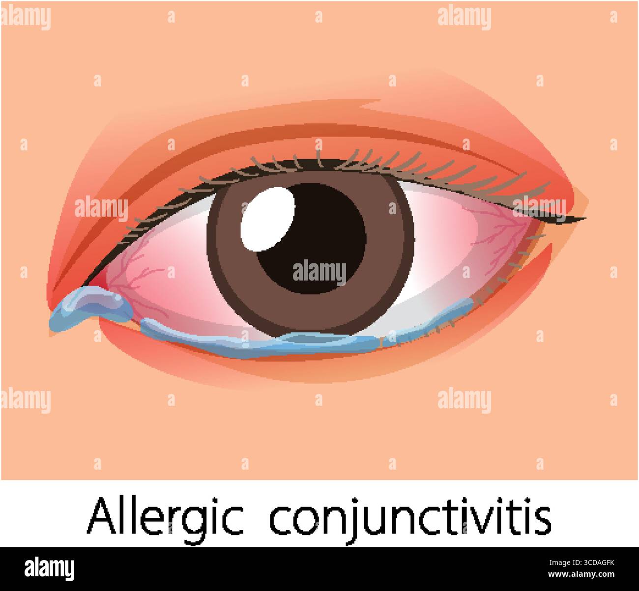 Vector illustration of a human eye showing redness, swelling, and ...