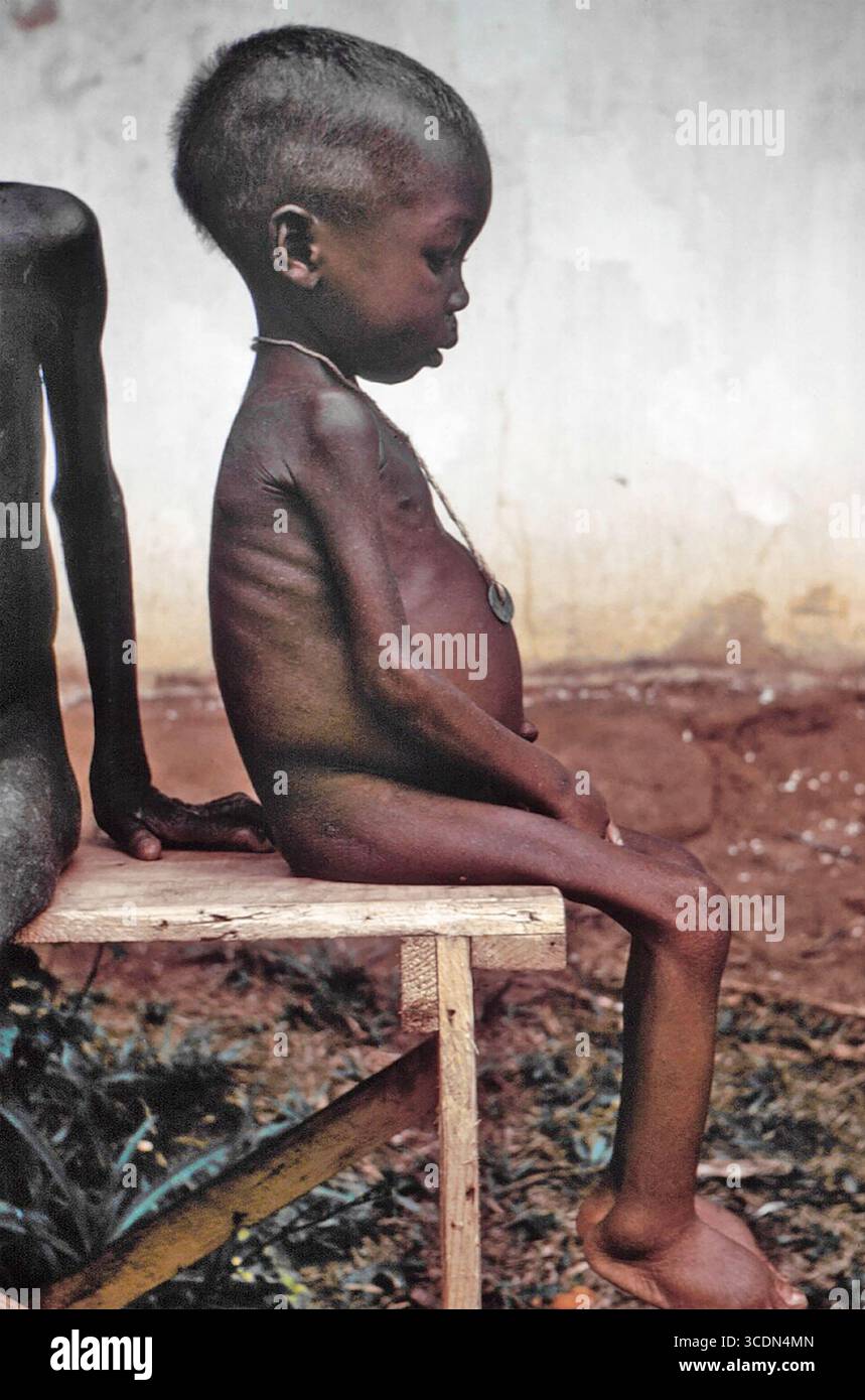 MALNUTRITION. A girl suffering from lack of food during the Nigerian blockade of Biafra in the  late 1960s. Photo: Dr. Lyle Conrad Stock Photo