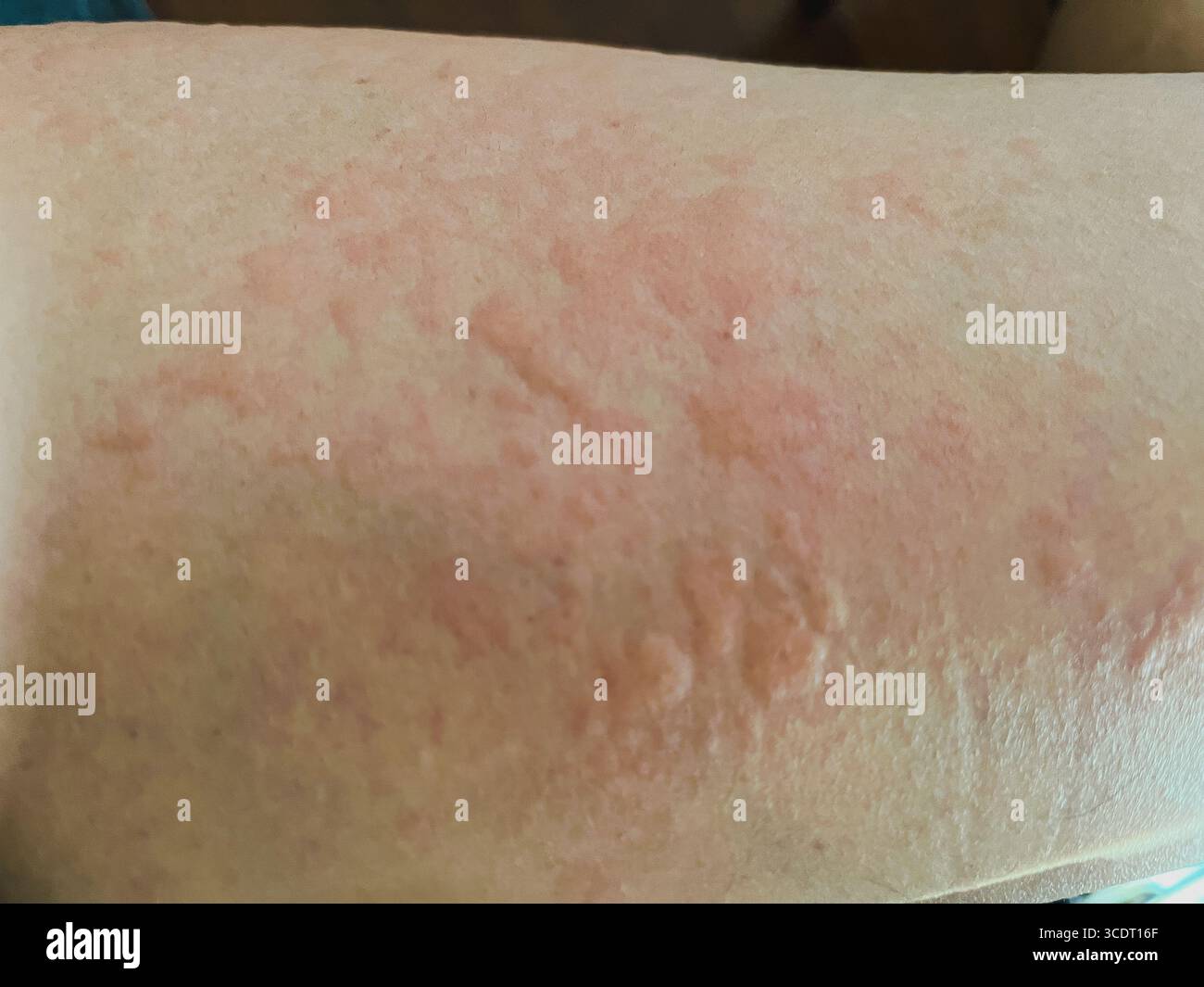 Pictures Of Hives Rash On Arms