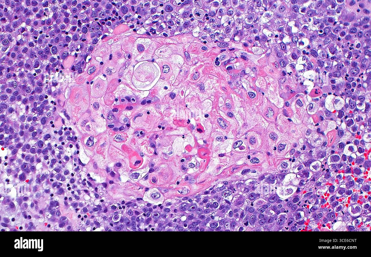 Light micrograph of urothelial carcinoma with squamous differentiation ...