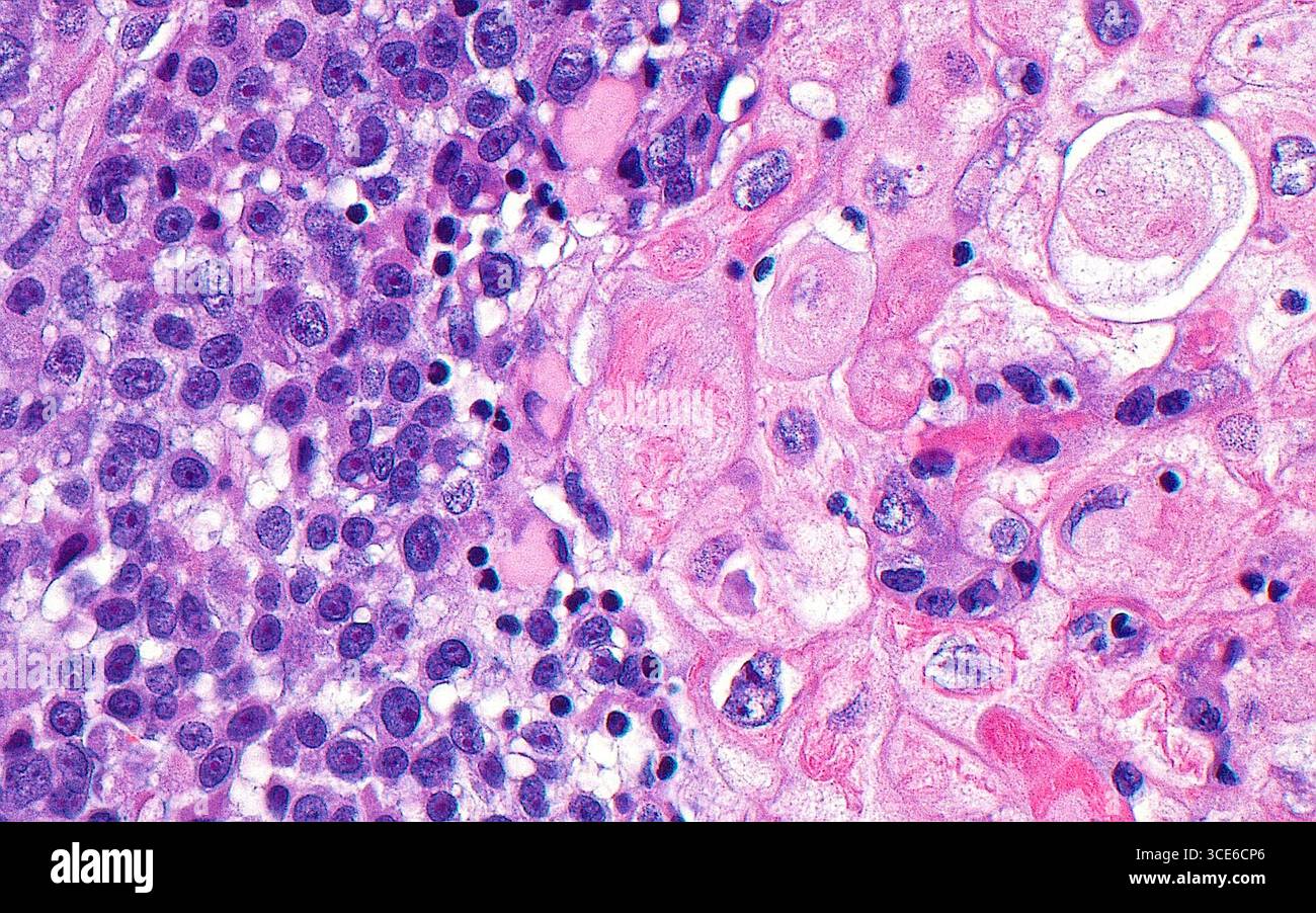 Light micrograph of urothelial carcinoma with squamous differentiation ...
