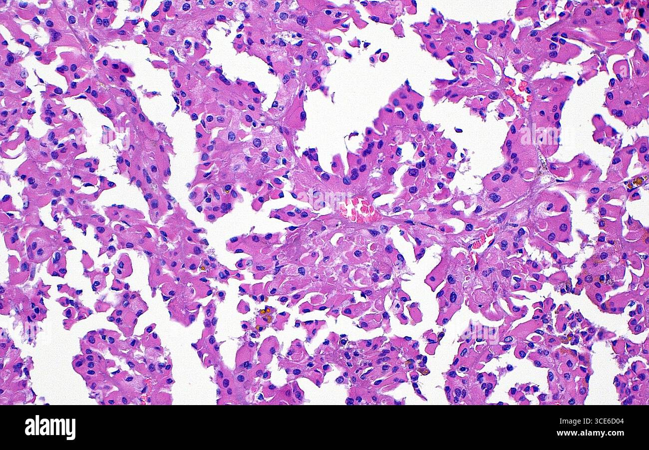 Renal tumour hi-res stock photography and images - Alamy