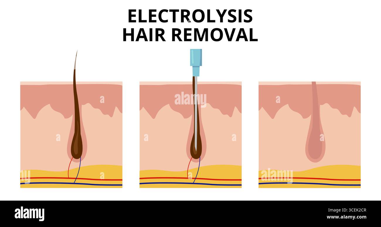Electrolysis hair removal process showing three steps, hair follicle ...