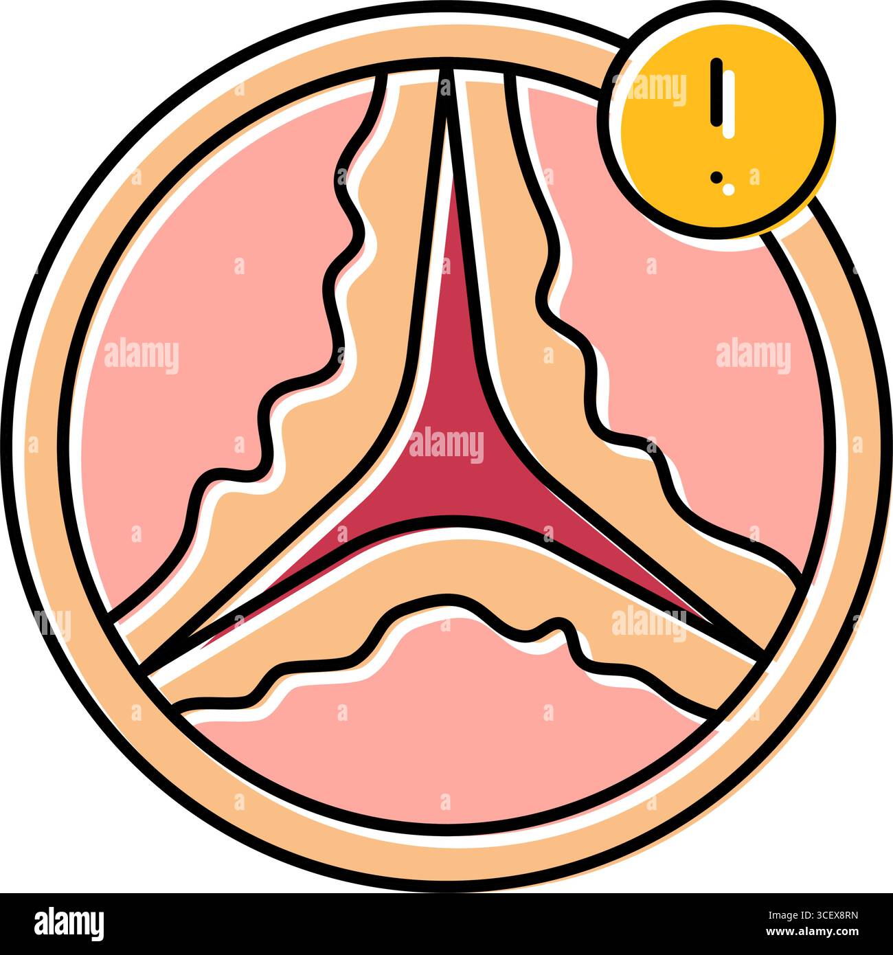 aortic stenosis cardiology disease color icon vector illustration Stock ...